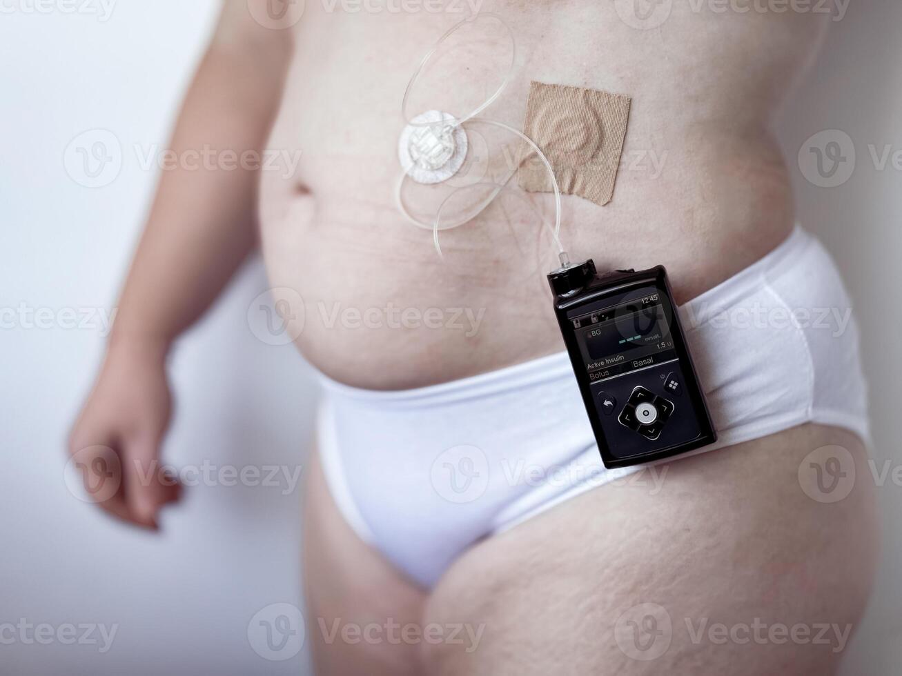 Person with insulin pump and glucose monitor for diabetes management photo