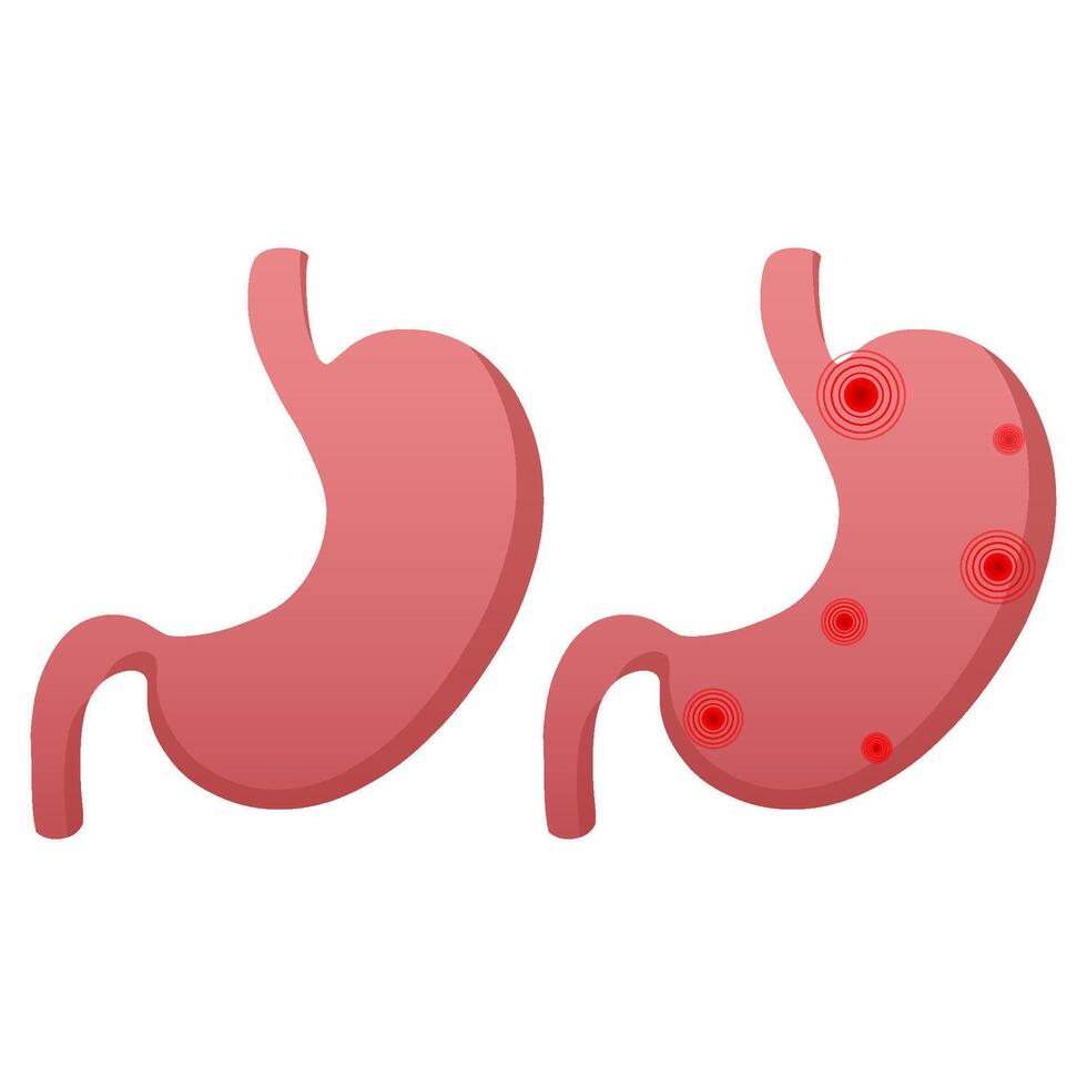 A set of healthy and sick stomach. Comparison of healthy stomach and stomach cancer. Anatomy of the digestive system. illustration vector