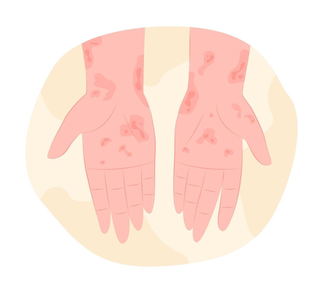 Eczema or Skin Rashes on Human Hands for Dermatology Concept Illustration vector