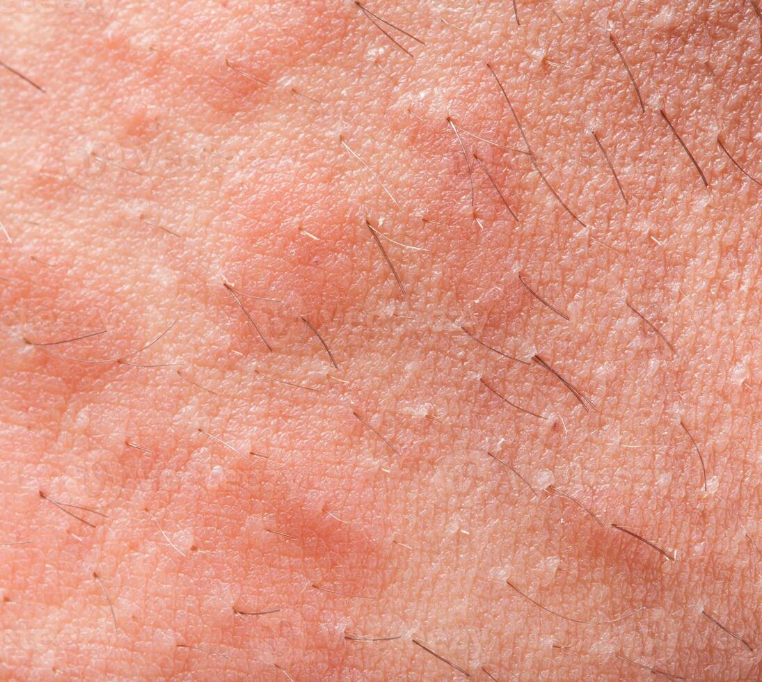 Eczema atopic dermatitis photo