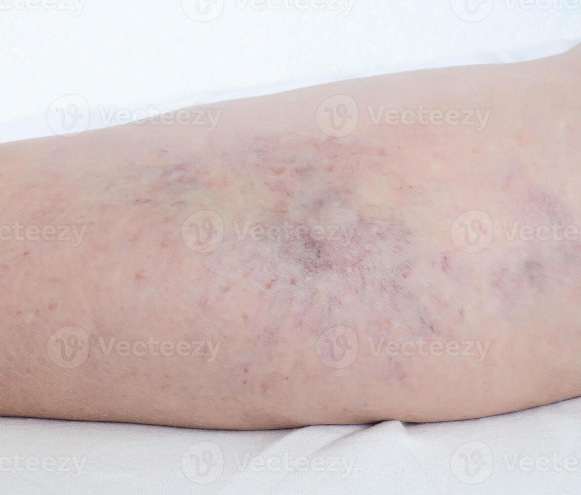 varicose veins on the legs of a person, thrombophlebitis, anatomical photo