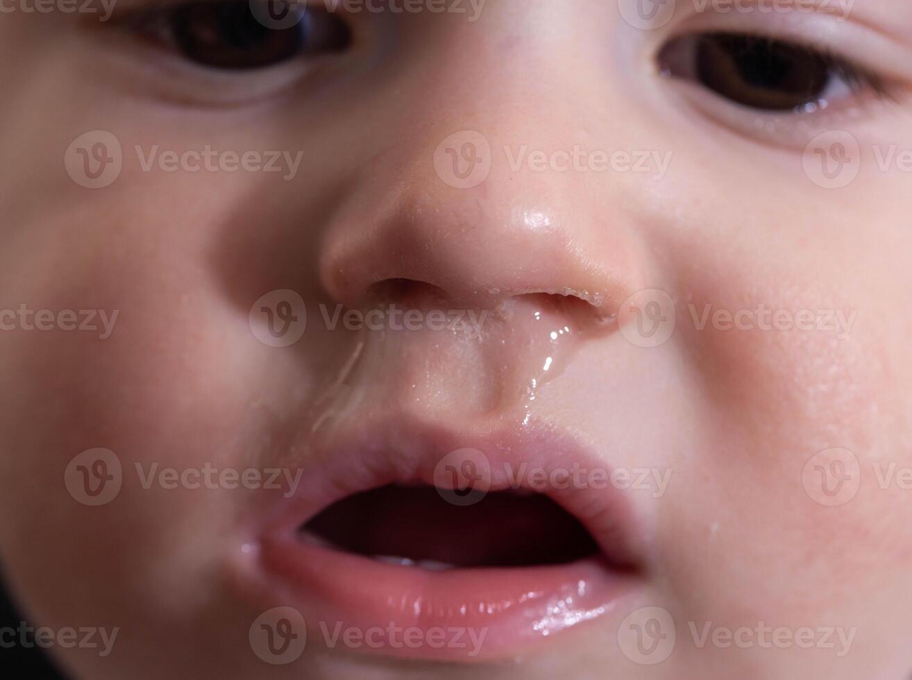 Bacterial diseases in the nose. Yellow snot from the nose of a little boy. Colds and infectious diseases, allergies. Close-up photo