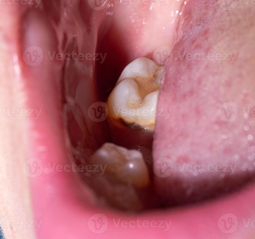 Hole after removal of a chewing tooth in the mouth. Healing of the gums after tooth extraction in dentistry, macro. Treatment photo