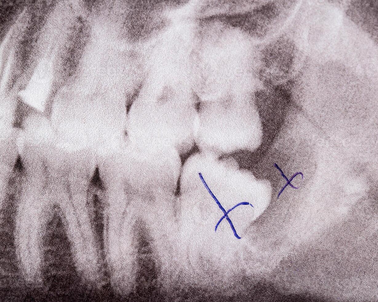 X-ray picture of teeth, removal of wisdom tooth and dental inflamed cyst, macro. Dental surgery concept, molar photo