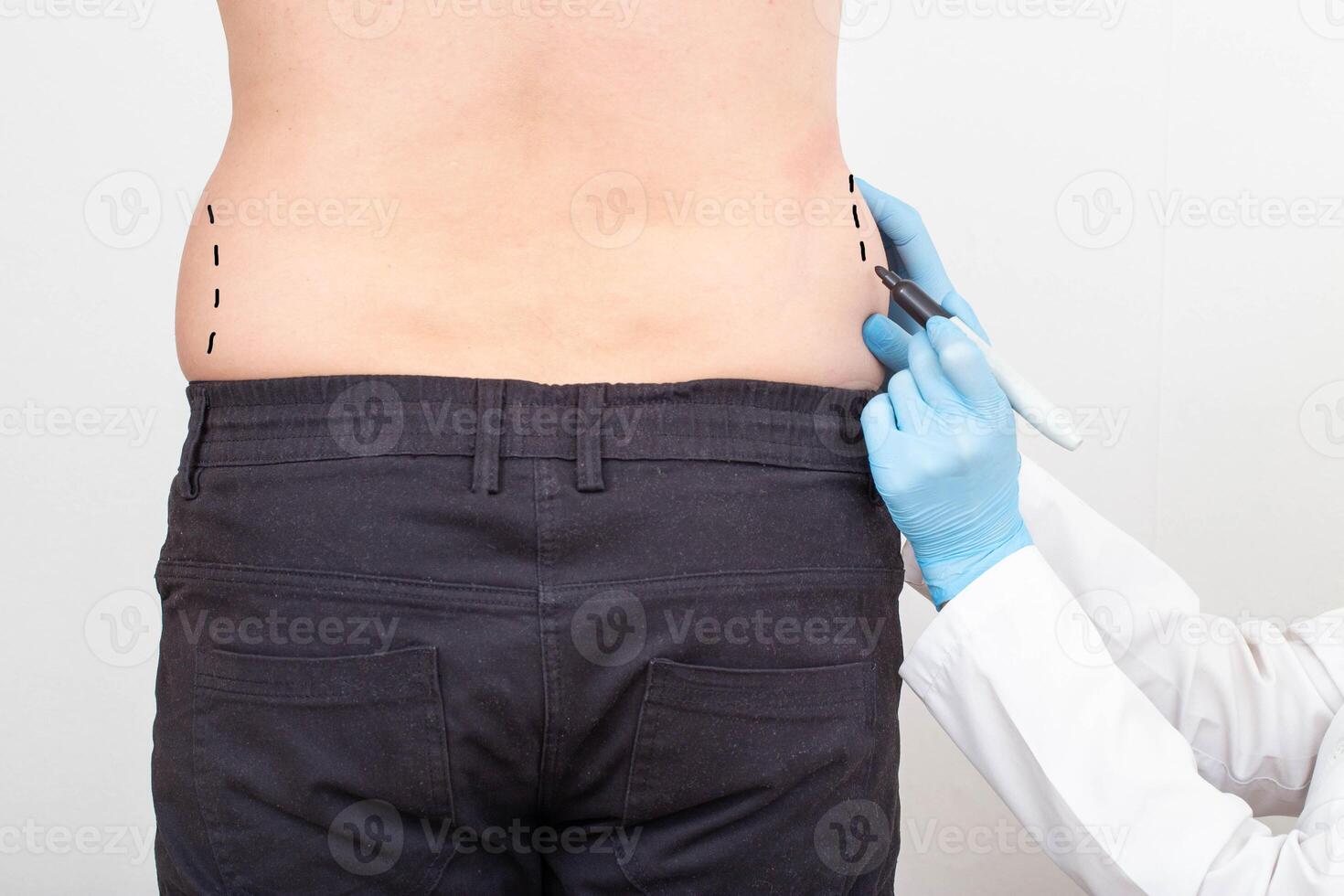 The plastic surgeon makes marks with a marker on the problem areas of the patient's thighs. Fat removal concept with plastic surgery, liposuction photo