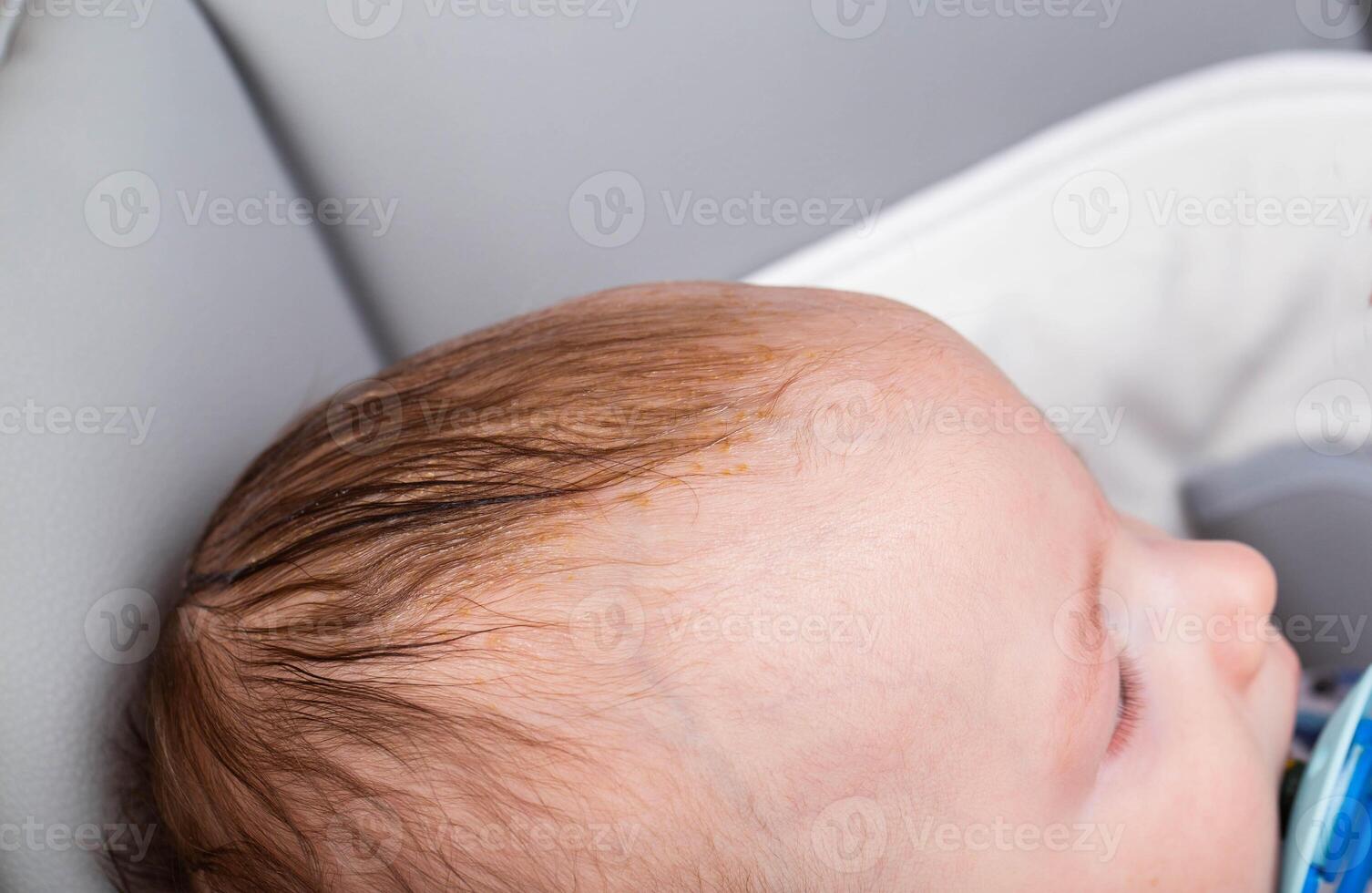 Smearing a seborrheic crust with baby oil on a child's head. Combing and removal of seborrheic crust, close-up. Copy space for text photo