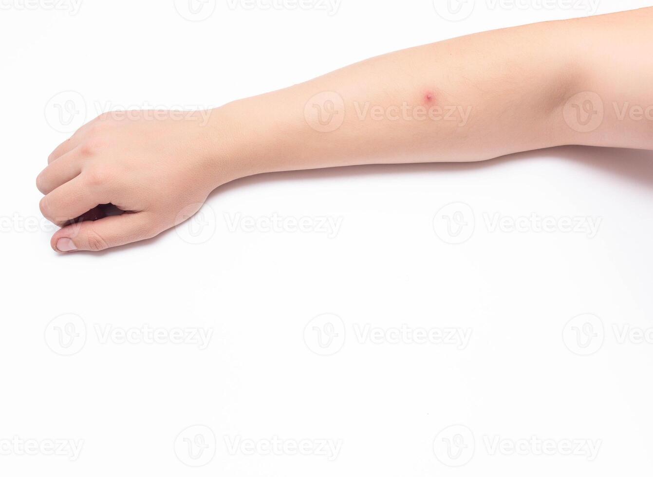 Red sore pimple on a person's hand, white background, close-up, copy space, inflammation photo