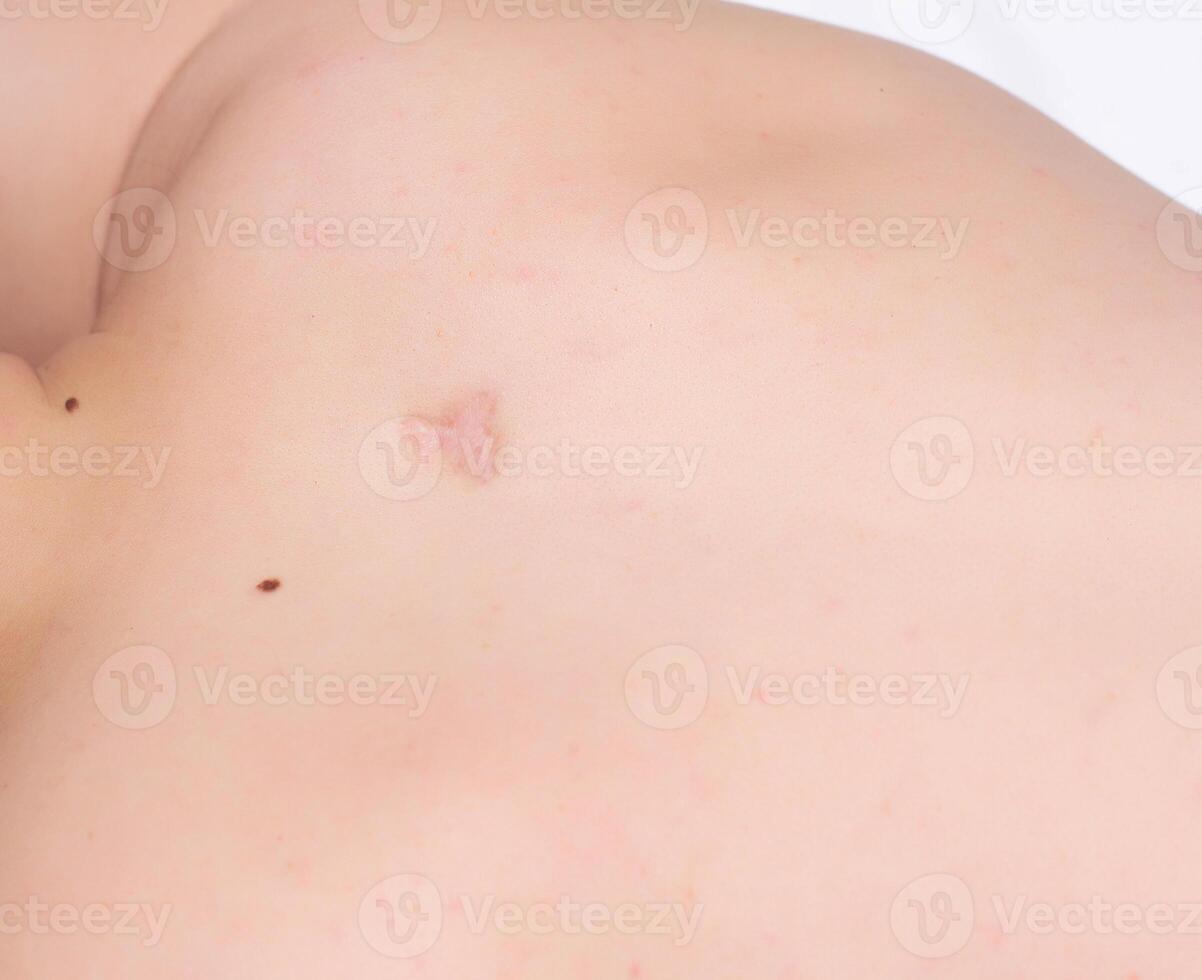 Scar on a man's back after removal of an inflamed boil, scar, close-up, copy space, healthcare photo