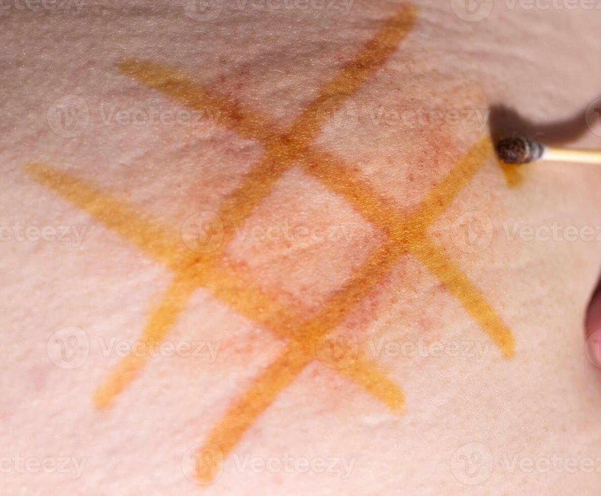 Application of iodine mesh to the seal after intramuscular injection of the drug. Treatment of post-injection infiltrates, close-up photo