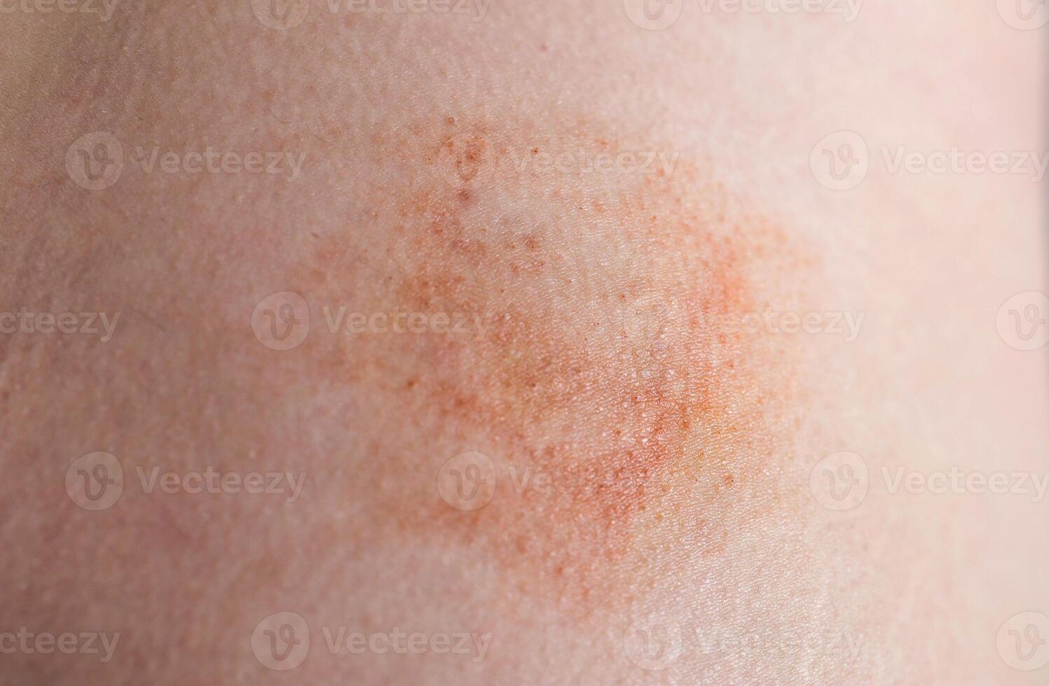 Bruise and subcutaneous lump on the patient s skin after injections. Post-injection infiltrates, close-up photo