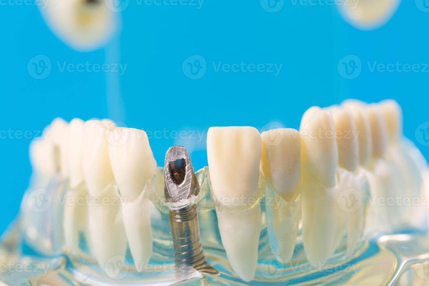 Dental pin in a medical model of the patient's jaw for putting on a dental crown. The concept of dental prosthetics in orthodontics, macro. Copy space for text, dentistry photo