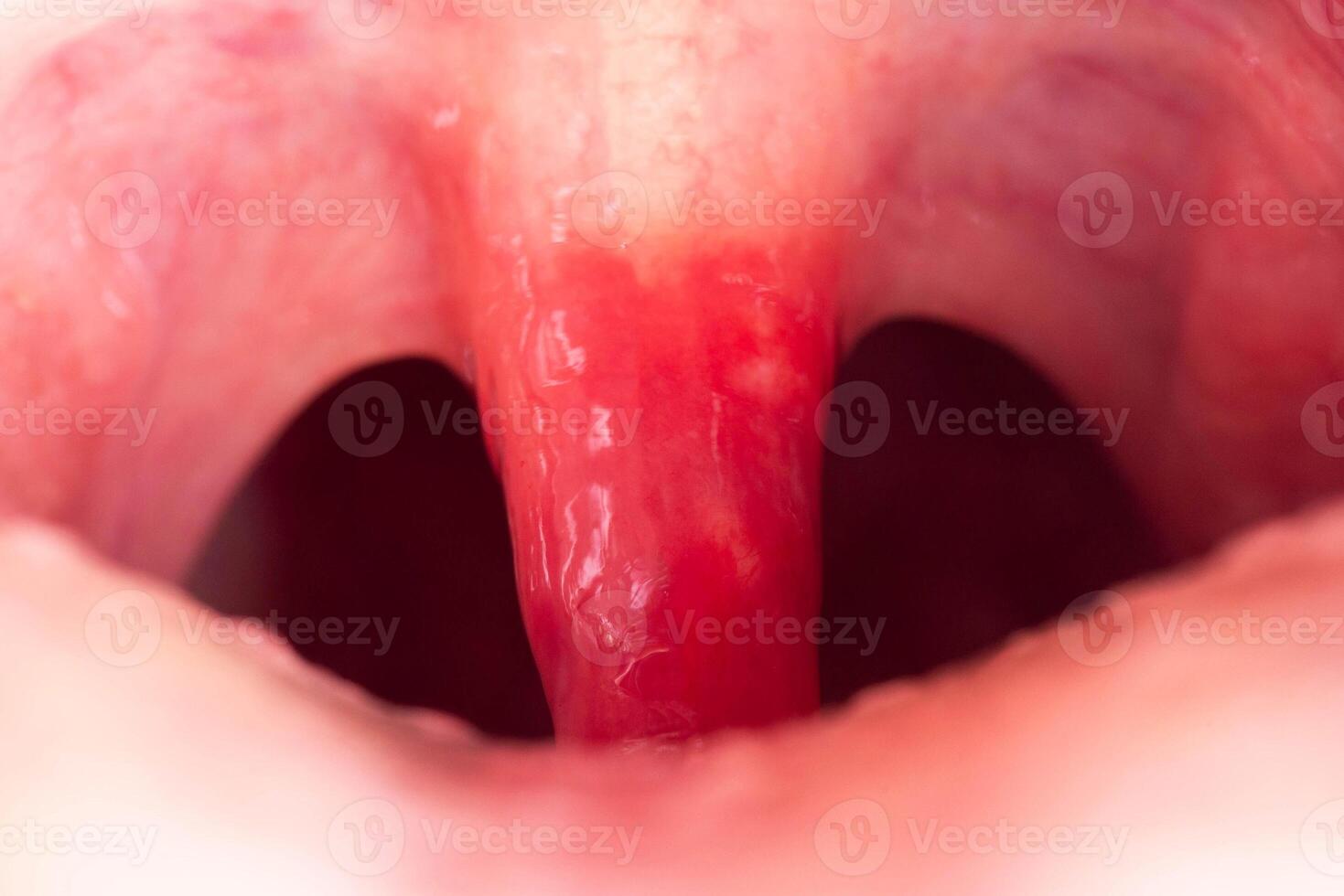 Long uvula with inflammation of infections and viruses. Treatment of uvulitis in children and adults. Sore throat, sore throat, macro. Allergy photo