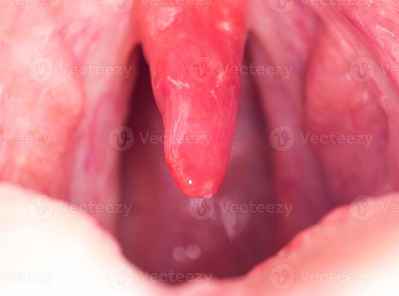 Long uvula with inflammation of infections and viruses. Treatment of uvulitis in children and adults. Sore throat, sore throat, macro photo