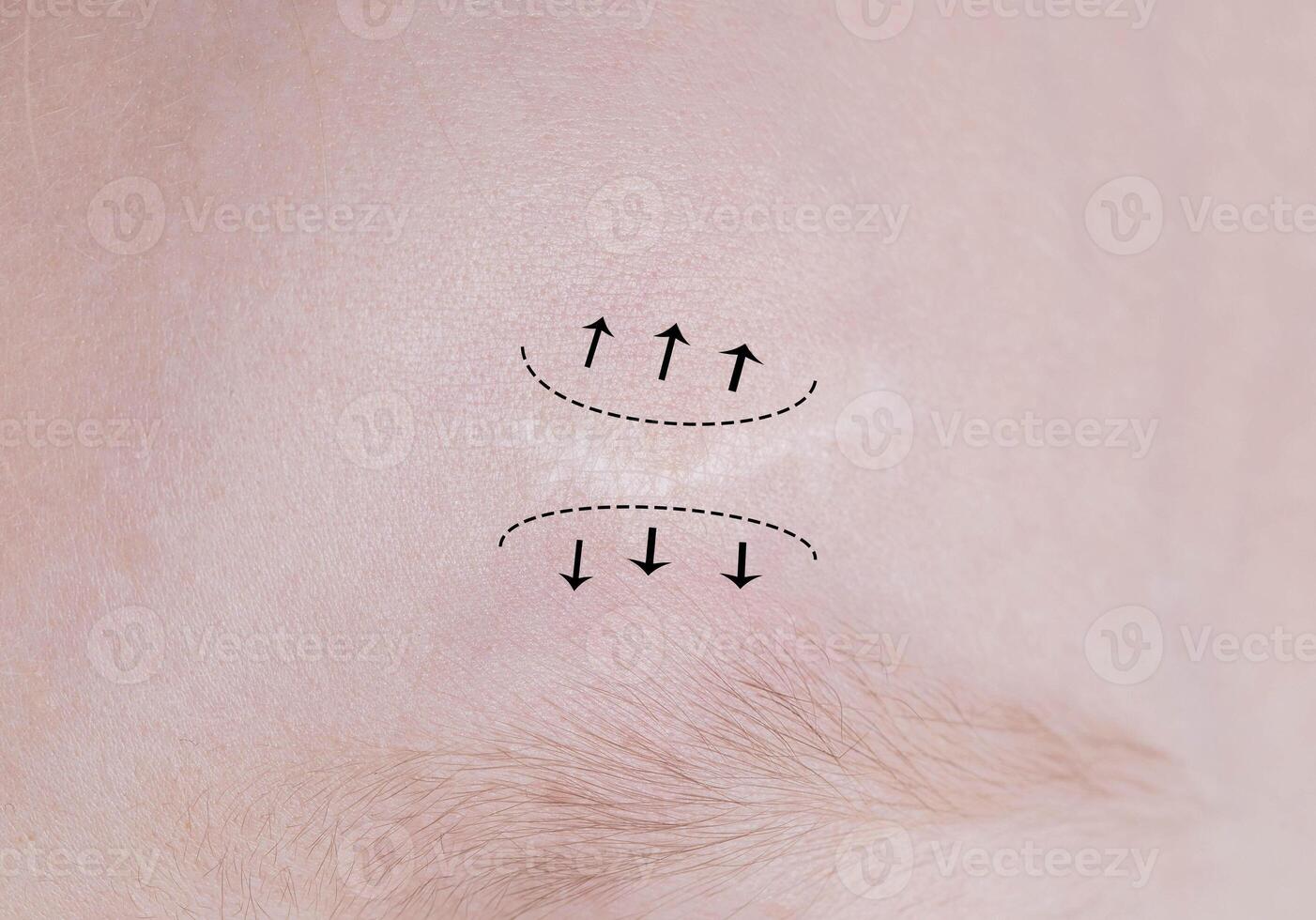 A scar on the forehead of a child with black marks before surgical correction of the scar. The concept of laser removal and correction of scars after trauma to the skin, close-up photo