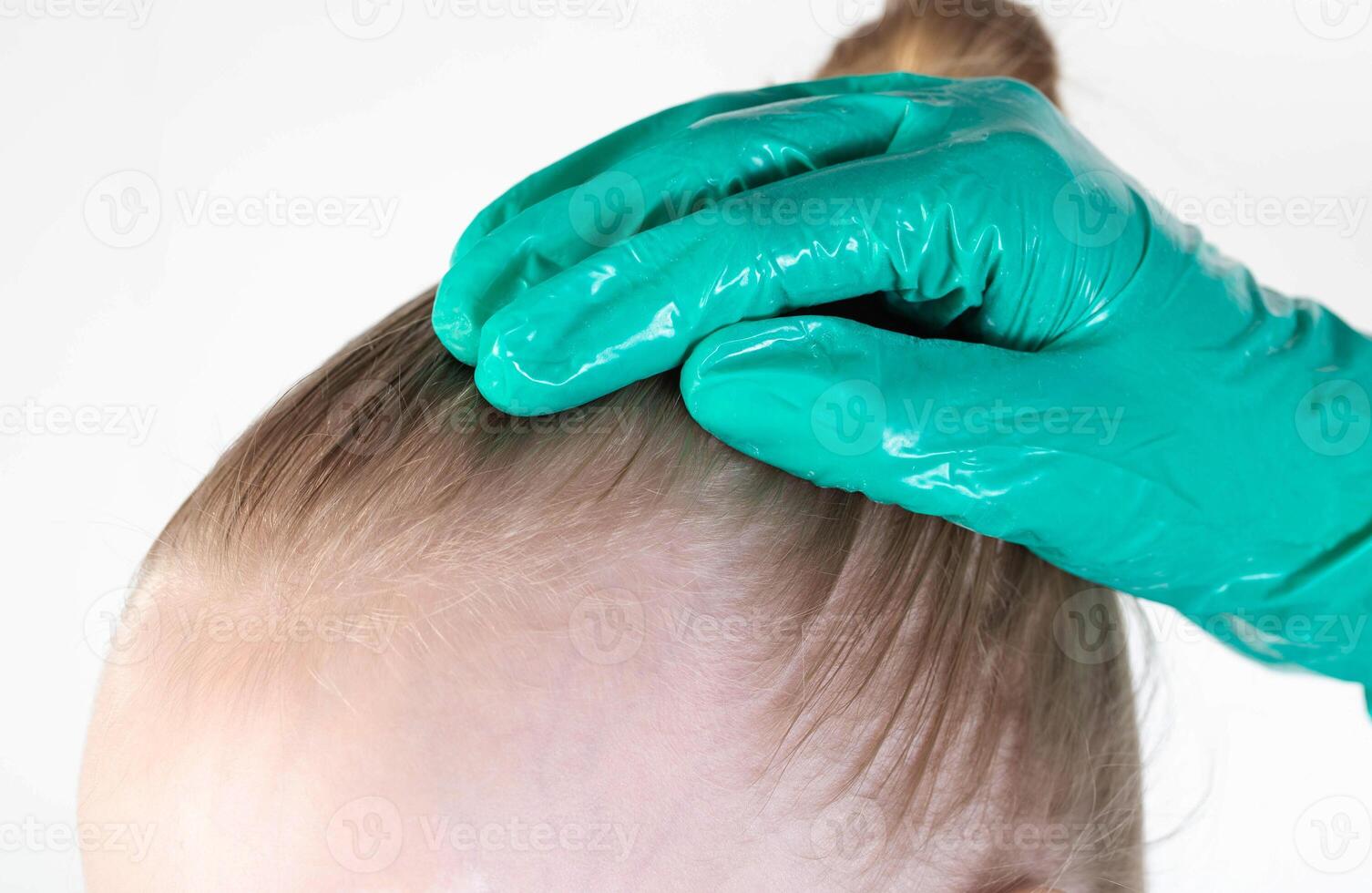 The doctor examines the girl's head and hair for bald spots and scalp baldness. Treatment of receding hairline in children, hair extensions, close-up photo