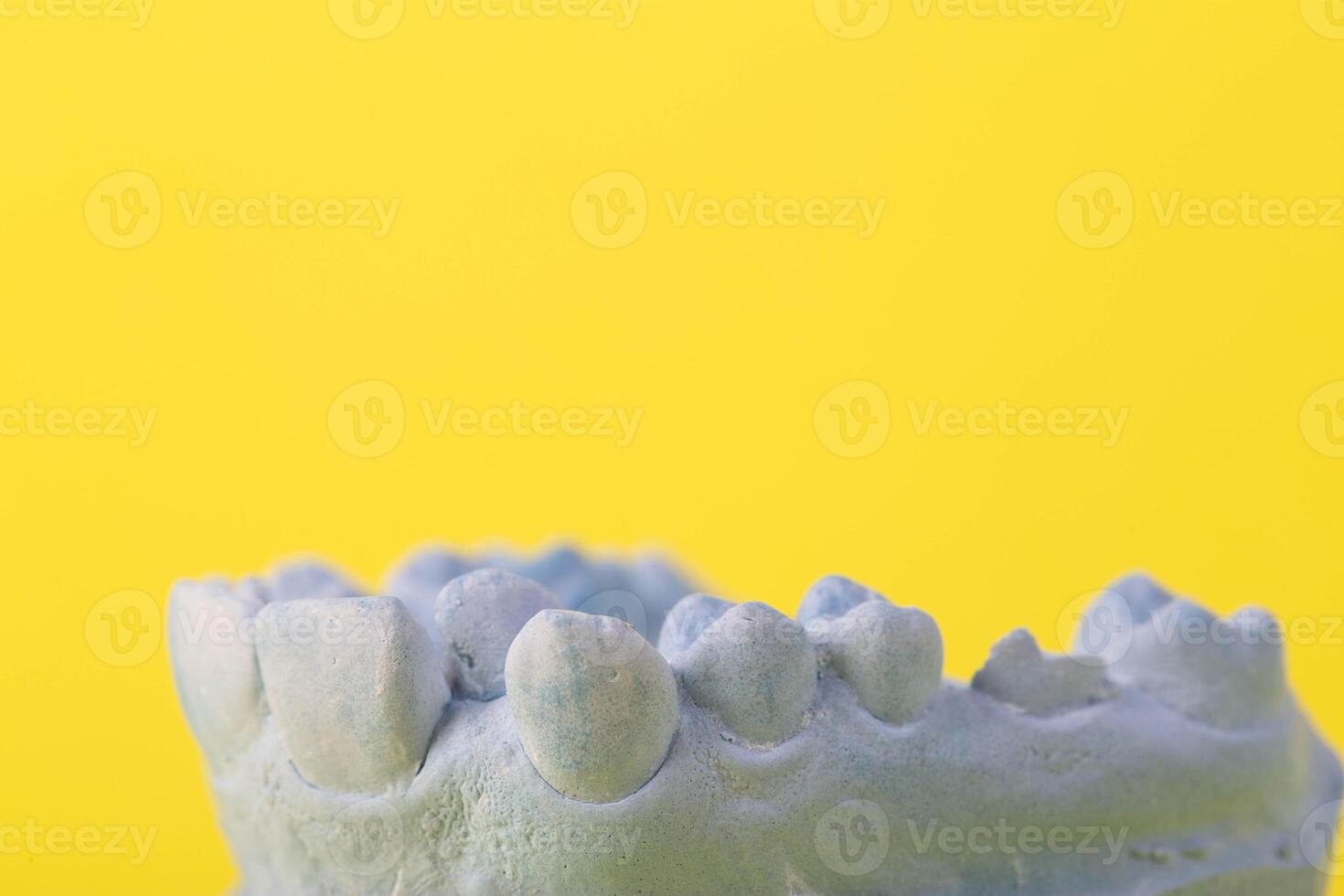 Blue plaster model of an impression of a patient's jaw at an orthodontist dentist on a yellow background. Manufacturing of dentures and crowns for dental prosthetics in orthodontics, macro. photo