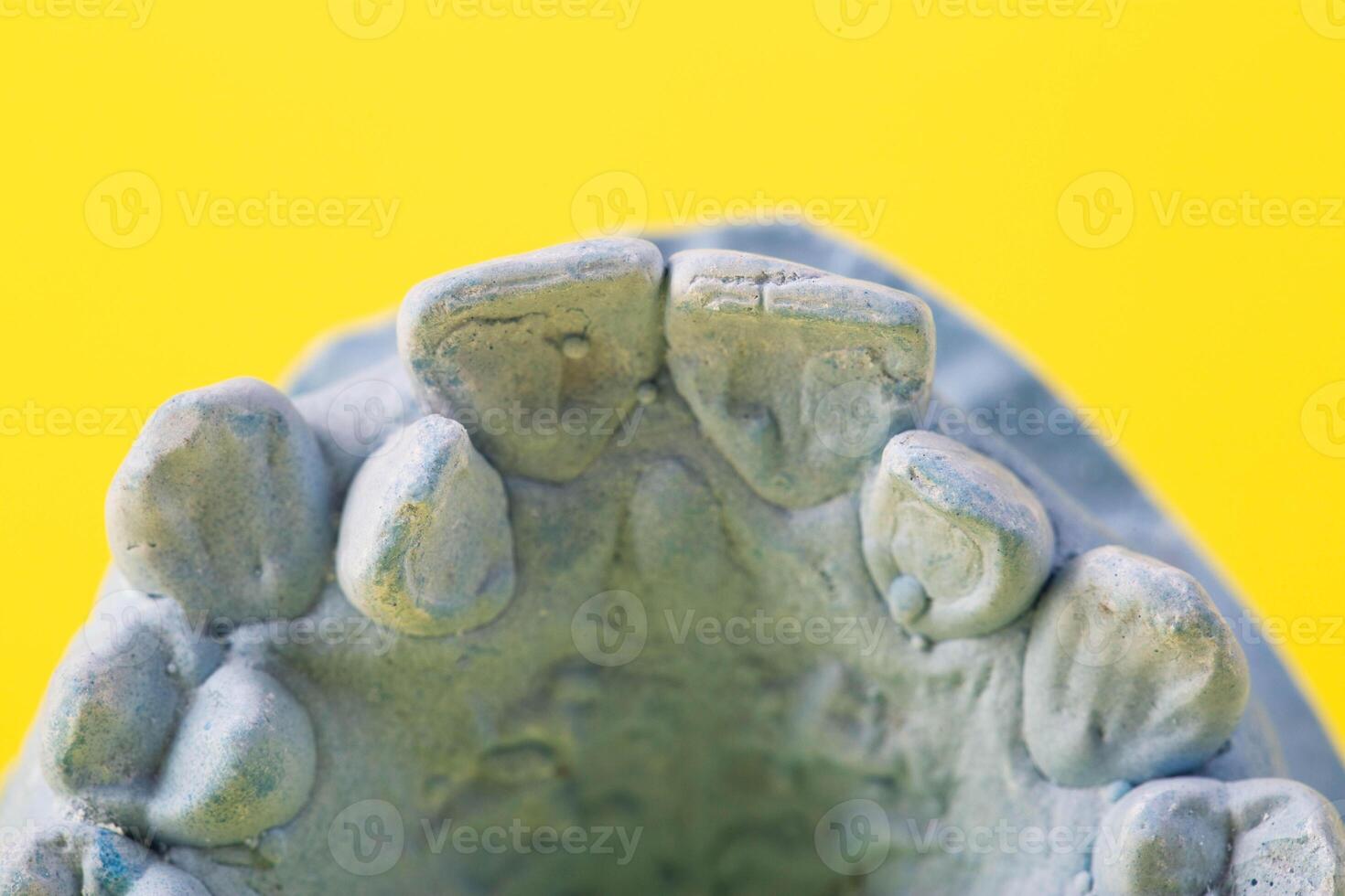 Blue plaster impression of a patient's dental jaw with crooked teeth and malocclusions on a yellow background. Manufacturing of braces to correct bite. View from above. Copy space for text photo
