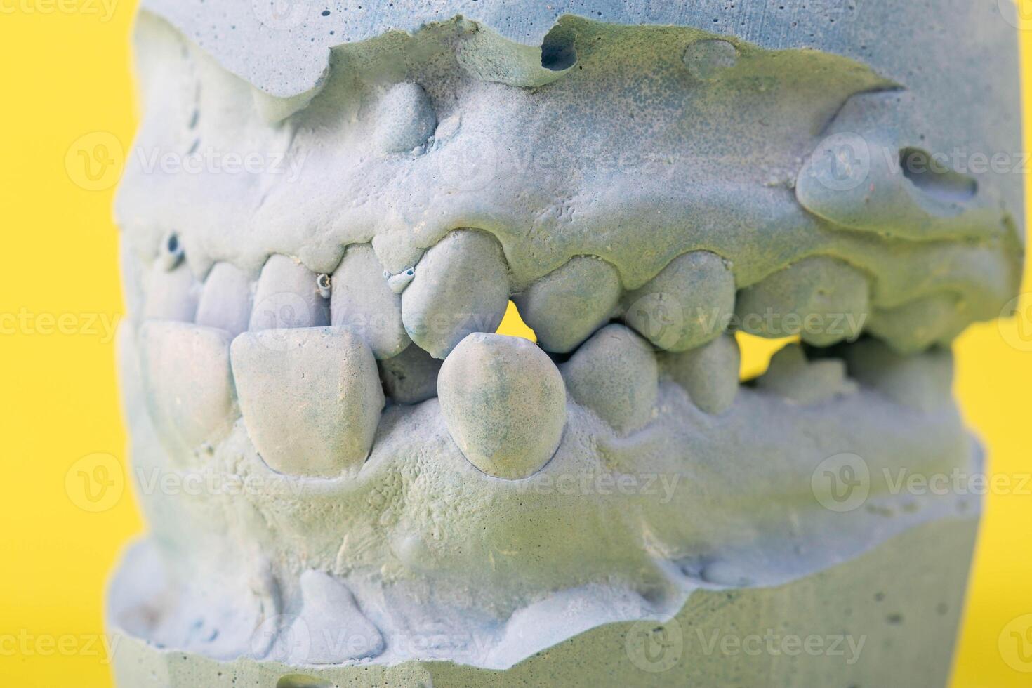 Blue plaster impression of the dental jaw of a patient with crooked teeth and malocclusions. Manufacturing of dentures and crowns based on orthodontic impressions, close-up photo