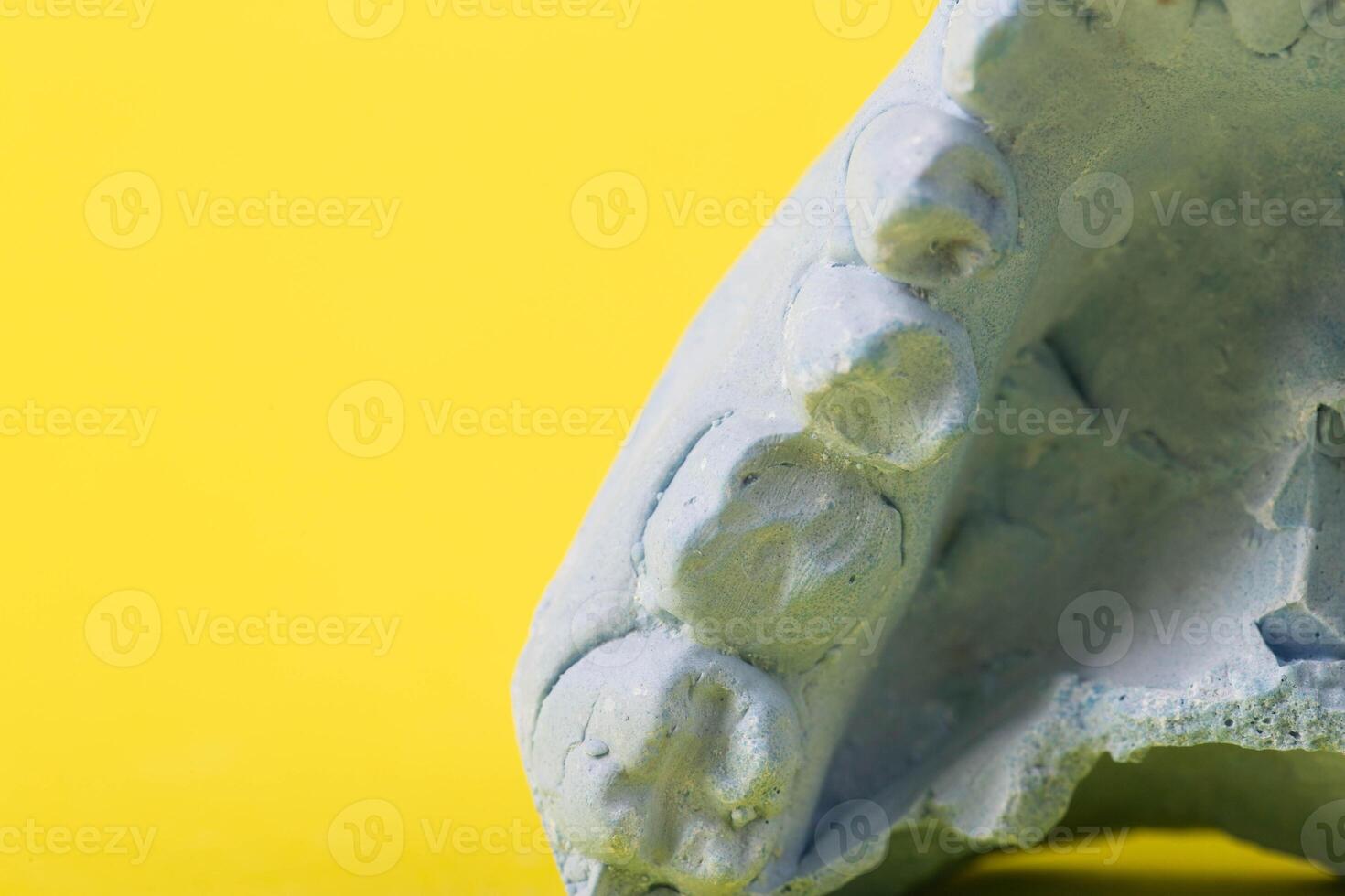 Blue plaster impression of a patient's dental jaw with crooked teeth and malocclusions on a yellow background. Manufacturing of bridges, crowns of various types, macro. Copy space for text photo