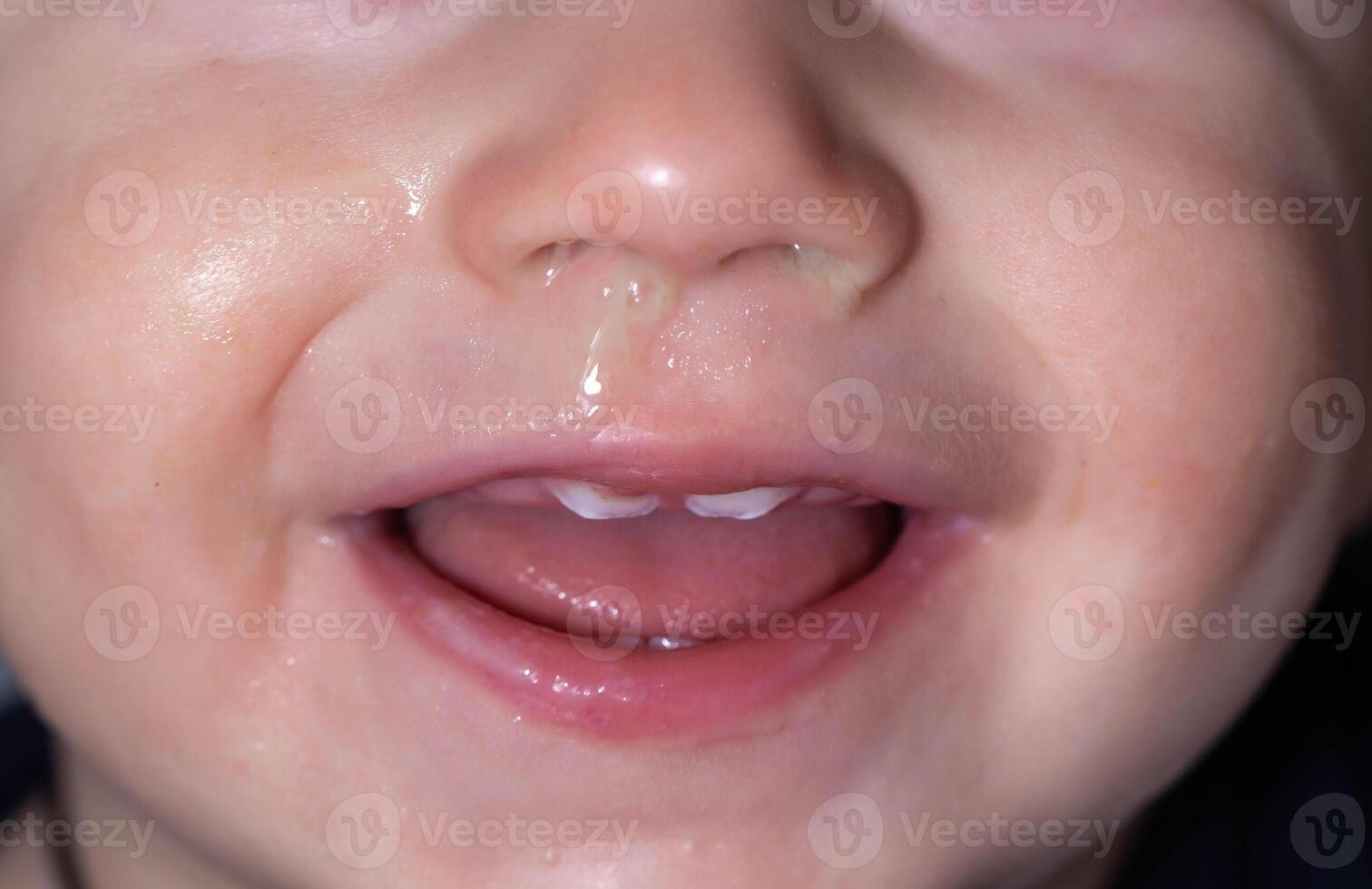 Close-up of a child's face, nose with snot and teething in the child's mouth. Concept of the reaction of snot from the nose to teething, therapy photo