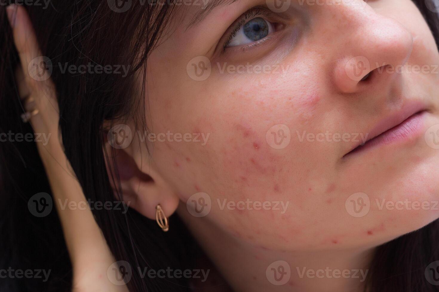 Portrait of a brunette girl with acne on her face, red pimples on the face of a young girl, close-up, caucasian photo