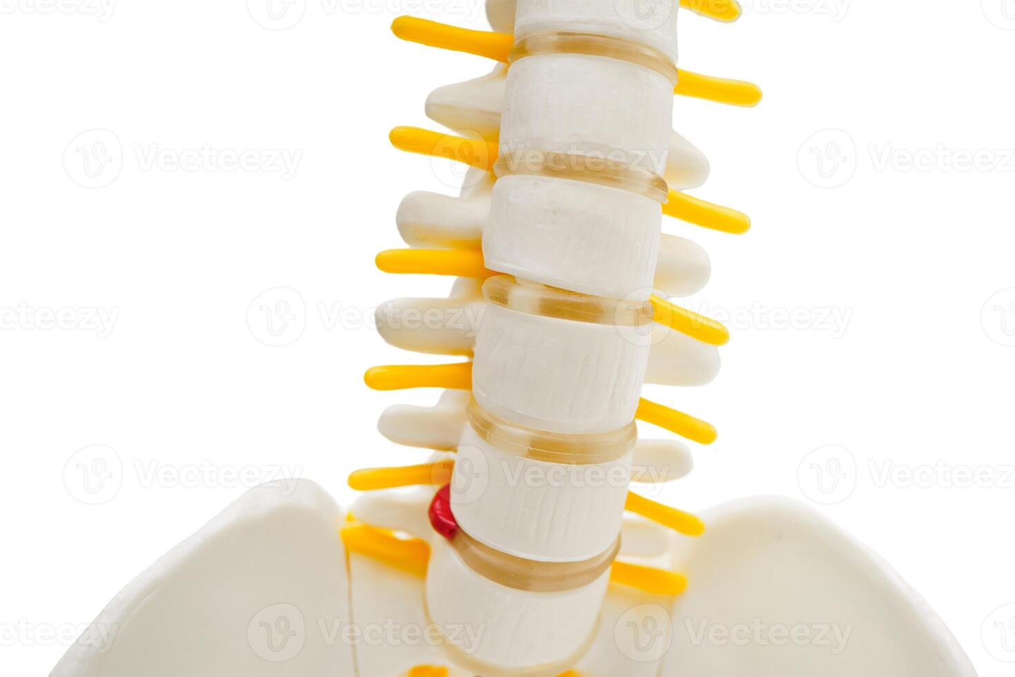 Spinal nerve and bone, Lumbar spine displaced herniated disc fragment, Model for treatment medical in the orthopedic department. photo