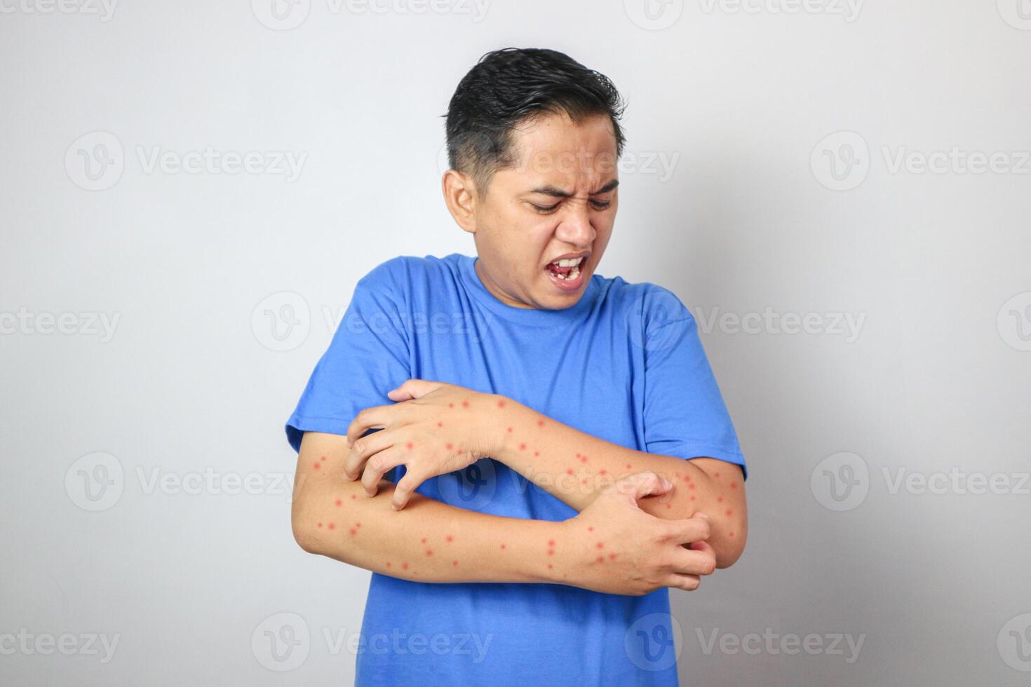 Concept of monkey pox infection, a white Asian man with pustular skin from monkeypox virus infection. photo