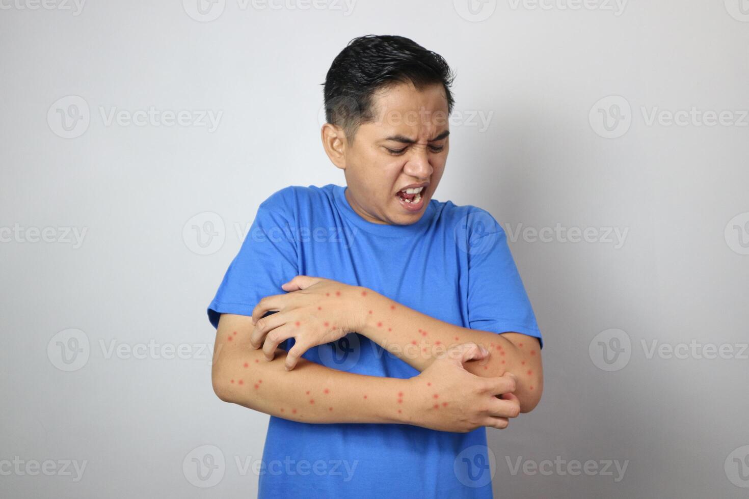 Men's hands showing rash due to Pox viral infection Painful red blistering skin Health problem in the palm of the hand Copy space. Allergic reaction Skin inflammation Dengue fever and Mpox disease. photo