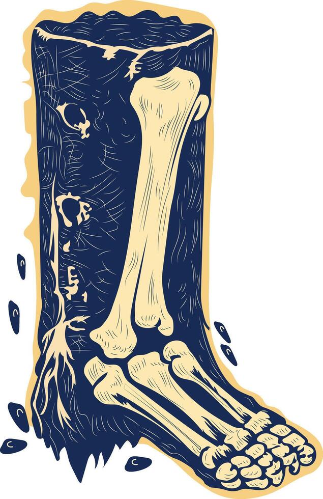 Foot bone crack illustration in vintage style vector