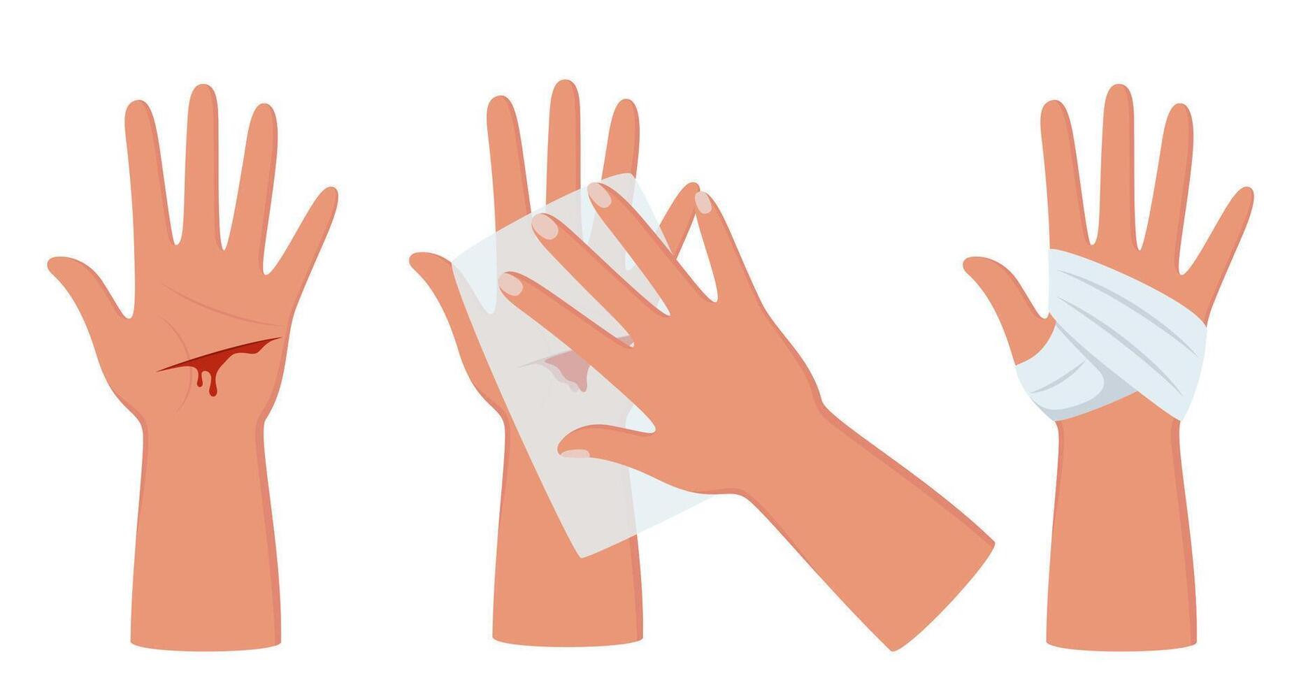 Bleeding cut on the palm, emergency situation. First aid treatment for wound on skin. Trauma, treatment procedure. illustration. vector