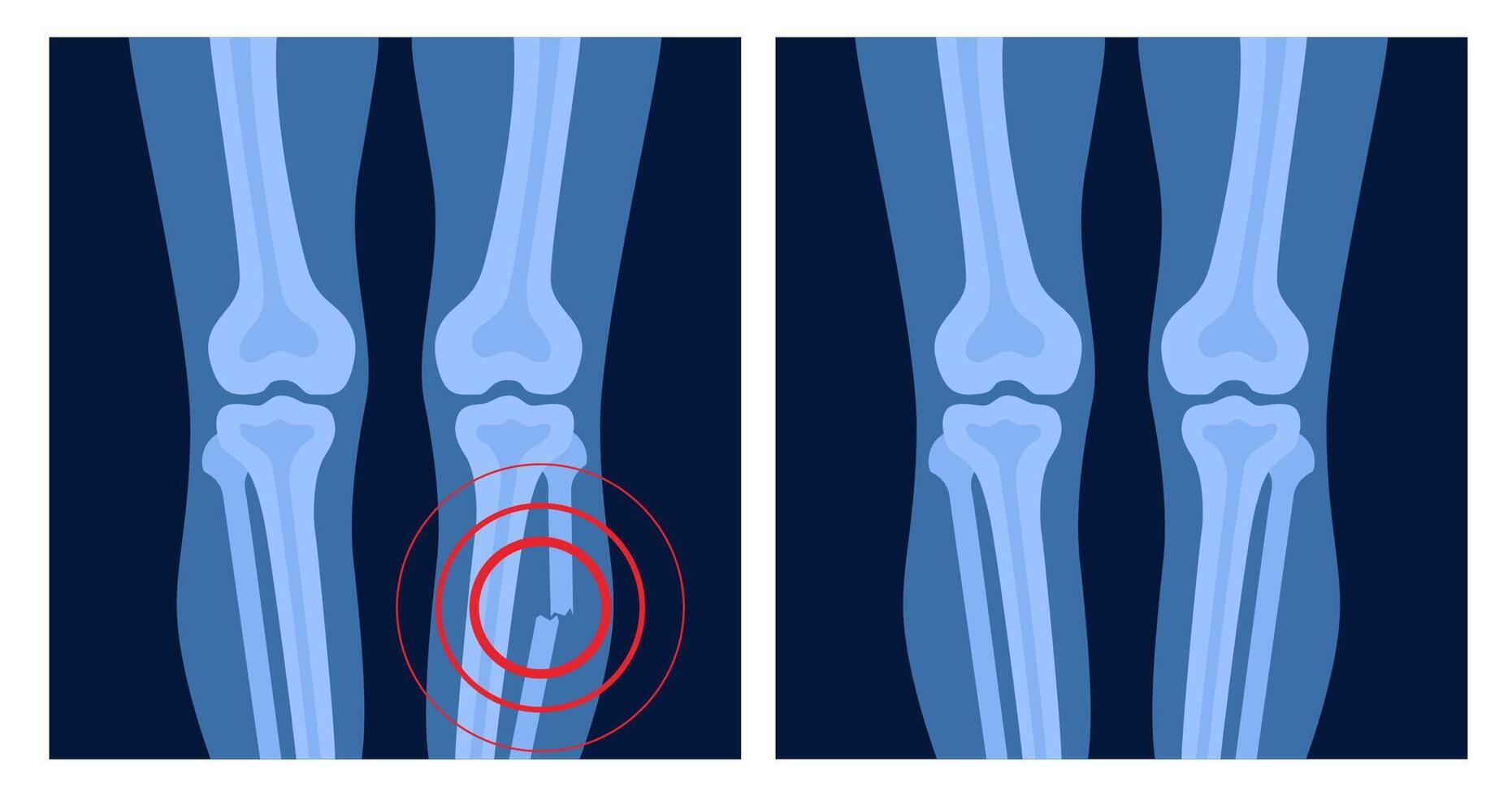 X ray of leg fracture with red pain point. Broken leg with open type of fracture. Human skeleton anatomy concept. Medical banner for clinic or hospital. illustration vector