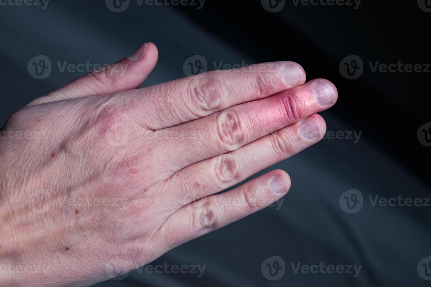 Mallet finger healing after splint removal from middle finger following joint trauma photo
