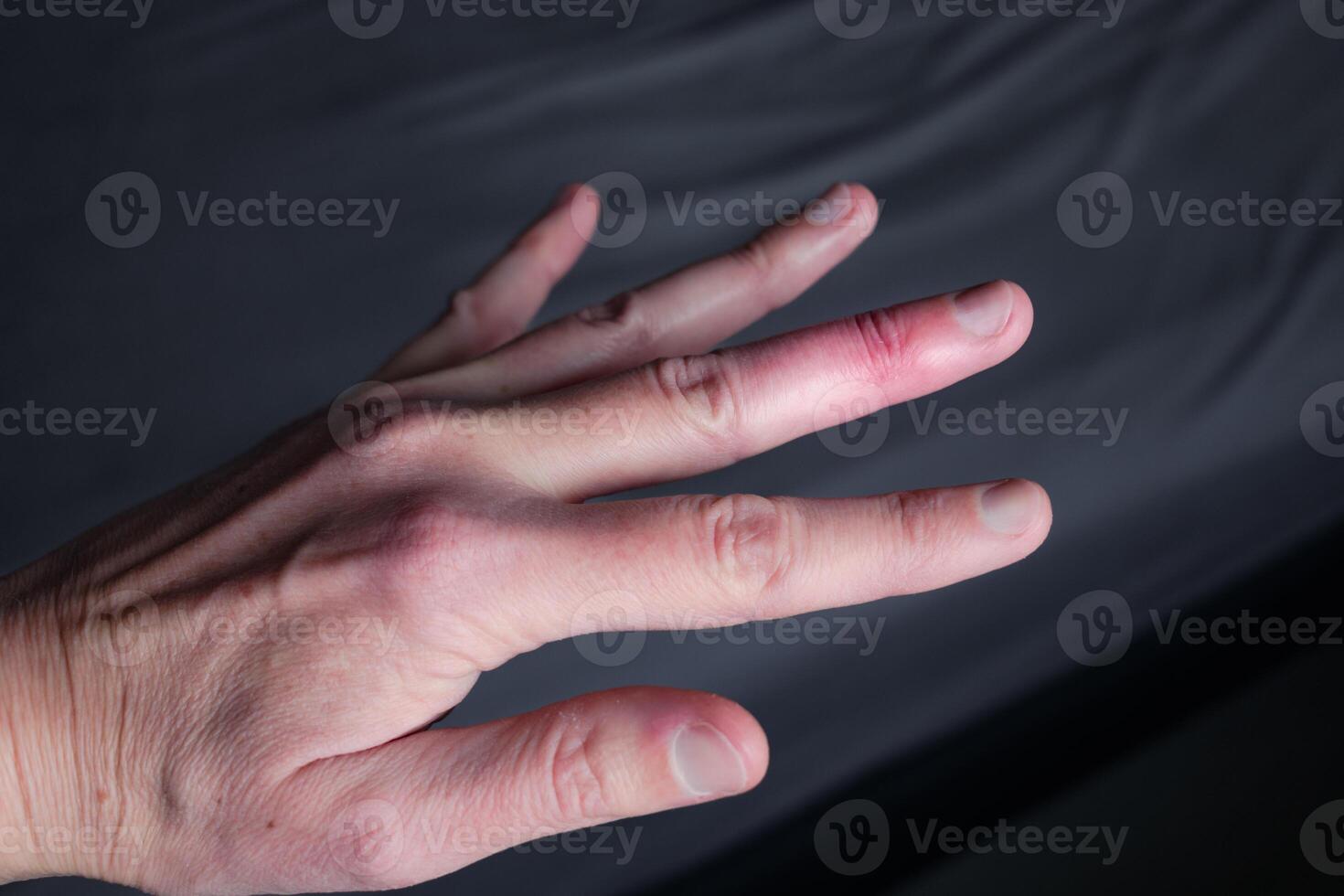 Mallet finger healing after splint removal from middle finger following joint trauma photo