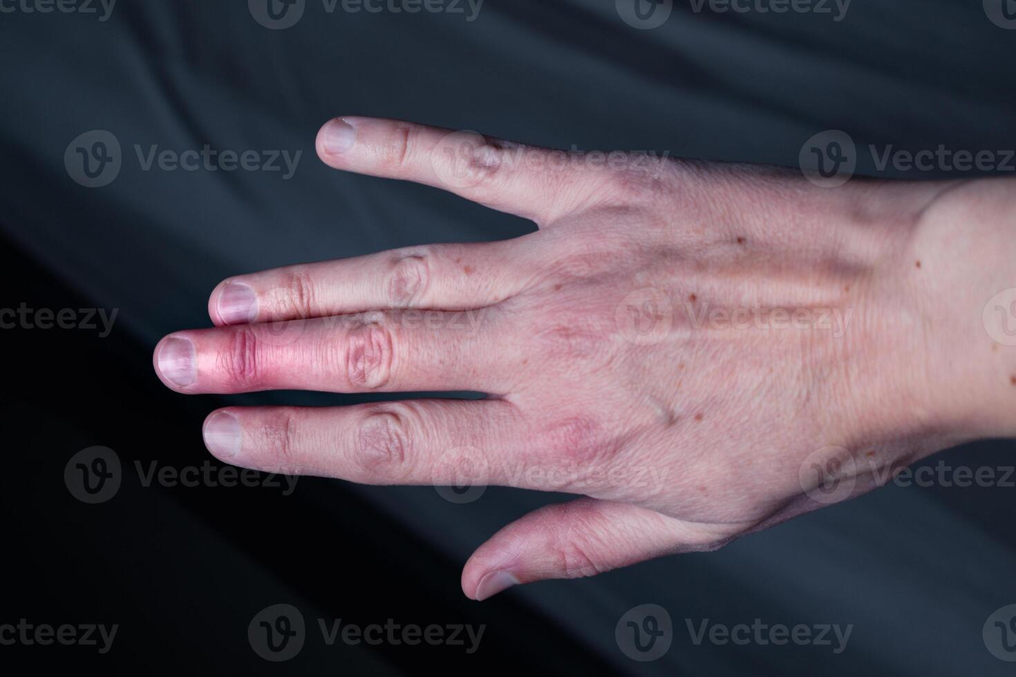 Mallet finger healing after splint removal from middle finger following joint trauma photo