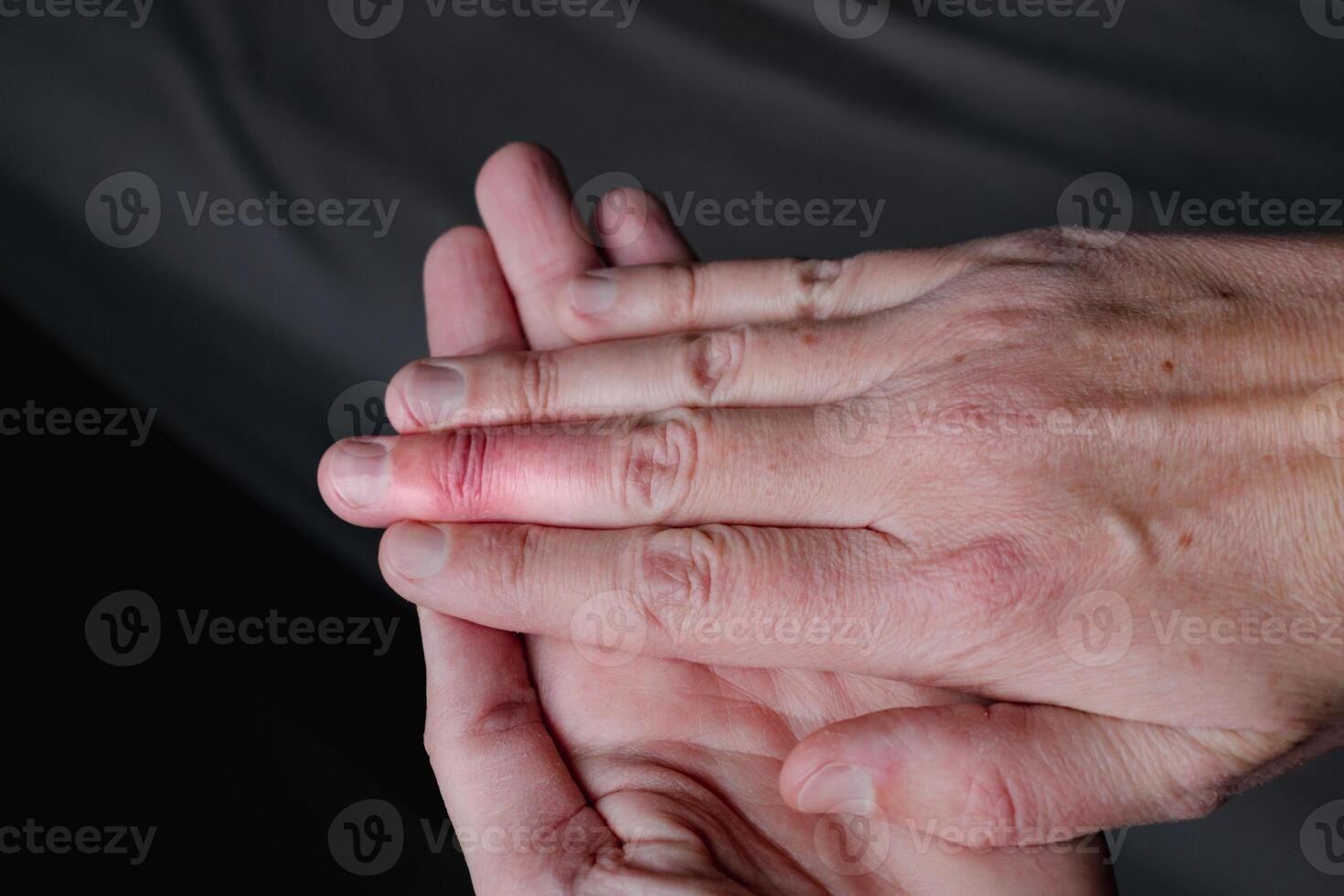 Mallet finger healing after splint removal from middle finger following joint trauma photo