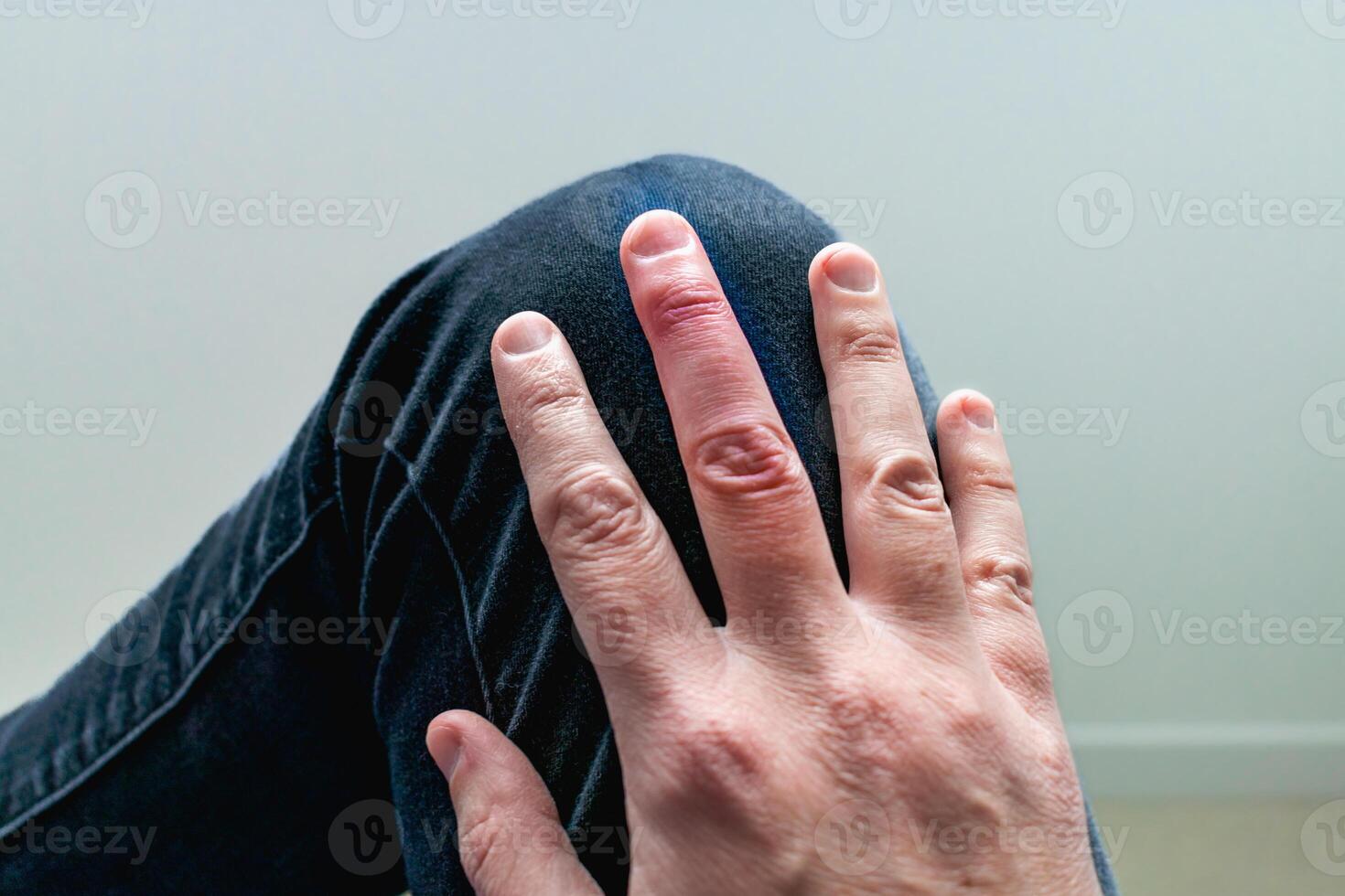 Mallet finger healing after splint removal from middle finger following joint trauma photo