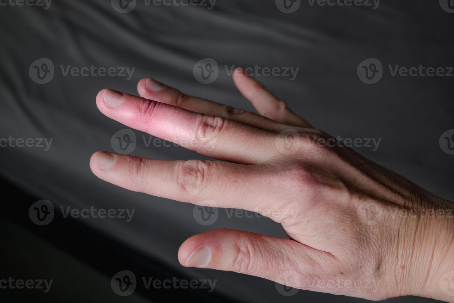 Mallet finger healing after splint removal from middle finger following joint trauma photo