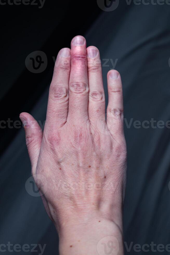 Mallet finger healing after splint removal from middle finger following joint trauma photo