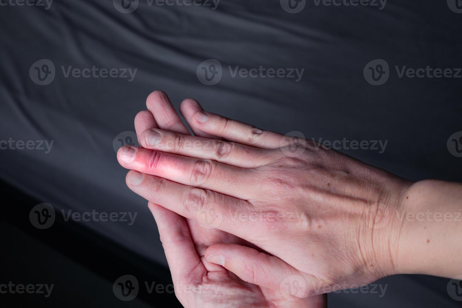 Mallet finger healing after splint removal from middle finger following joint trauma photo