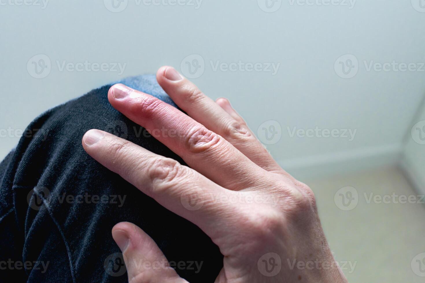 Mallet finger healing after splint removal from middle finger following joint trauma photo