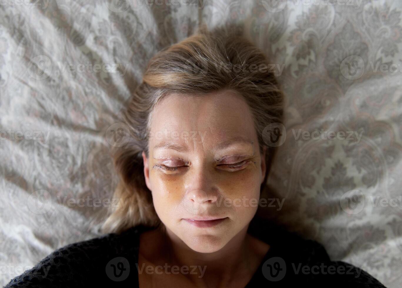 Middle-aged woman selfie seven days after double eyelid blepharoplasty surgery, top view photo