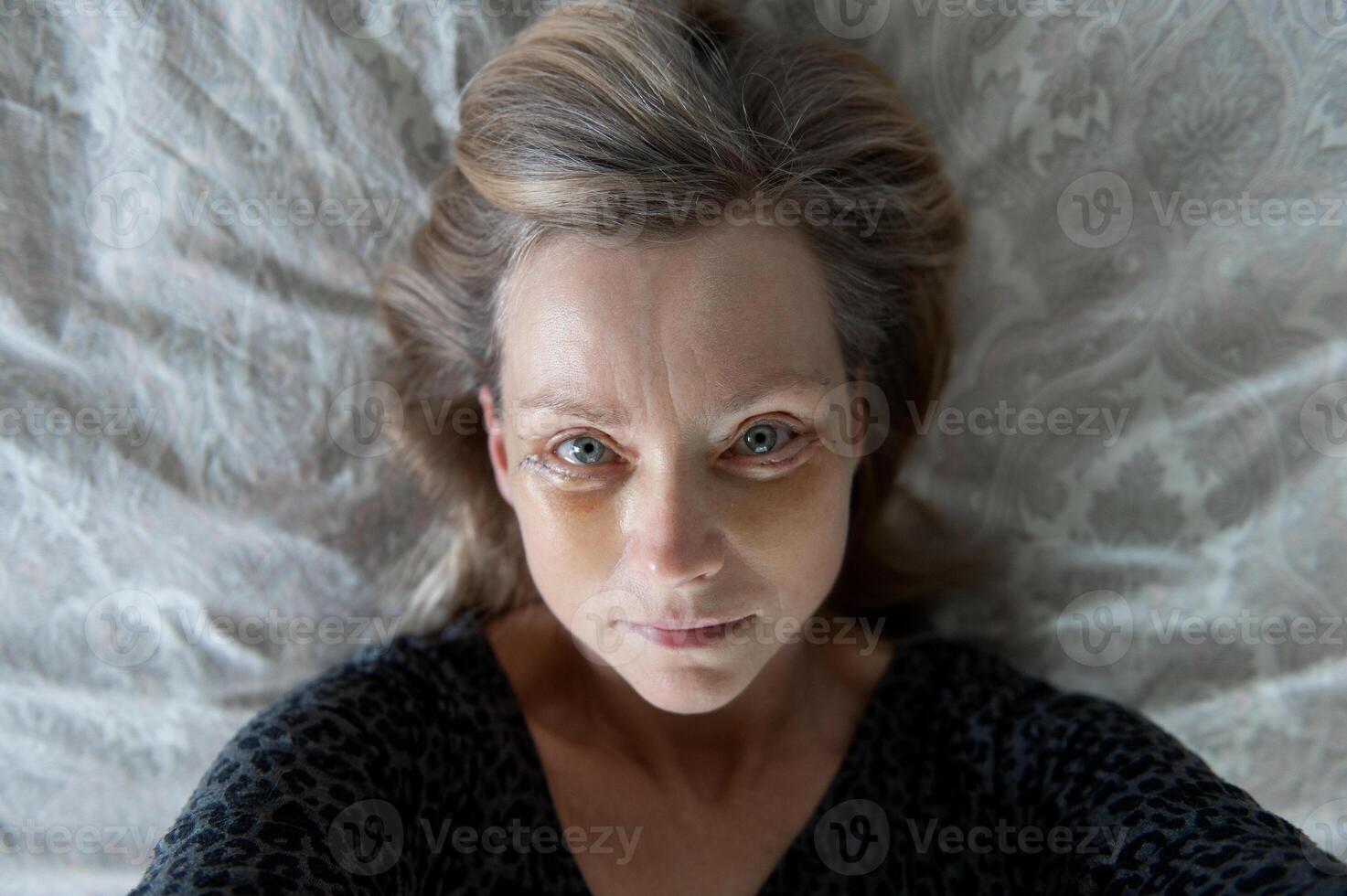 Top view on woman face seven days after double eyelid blepharoplasty surgery photo