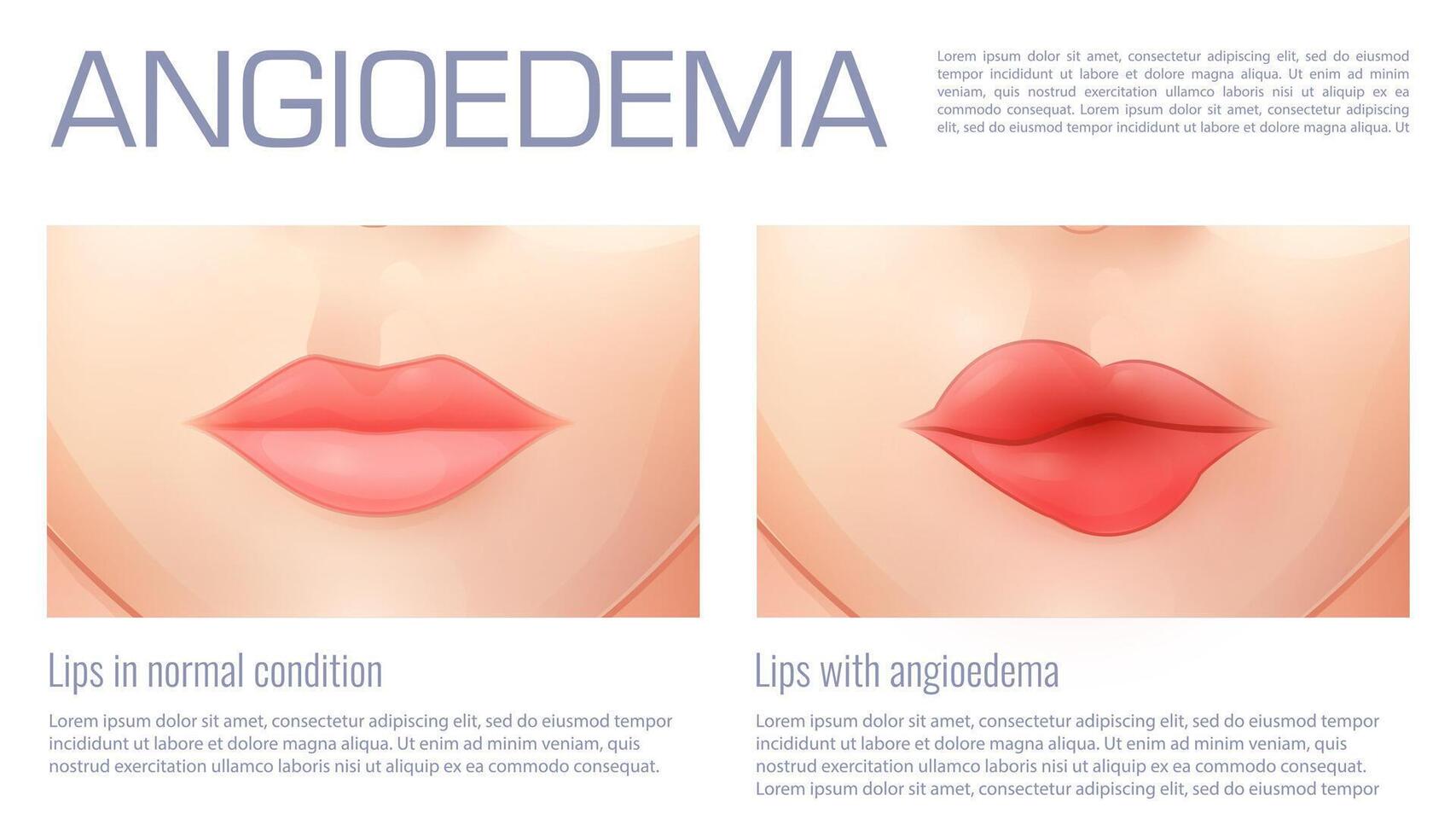 Swollen lips from angioedema or edema swelling vector