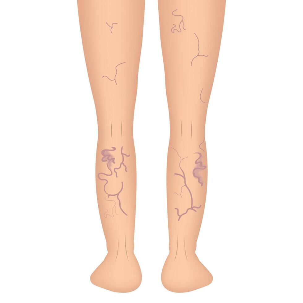 The external sign of dilated skin vessels. Symptoms of vascular lesions of the legs. Varicose veins vector