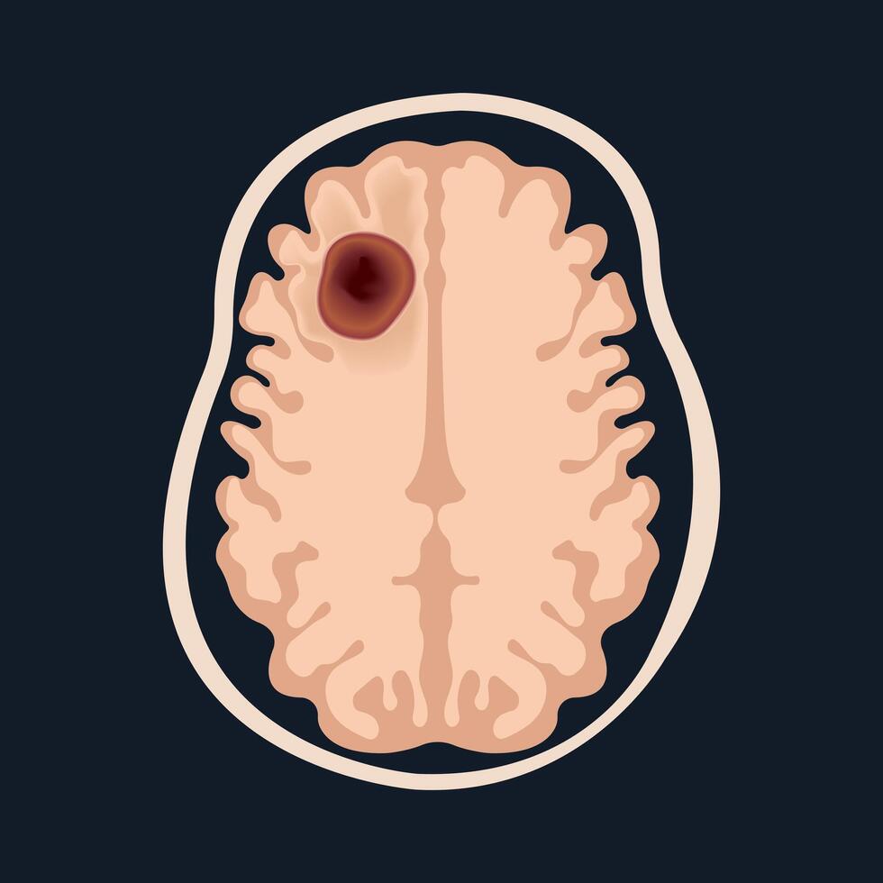 Section of the brain.MRI of the brain shows frontal glioblastoma vector