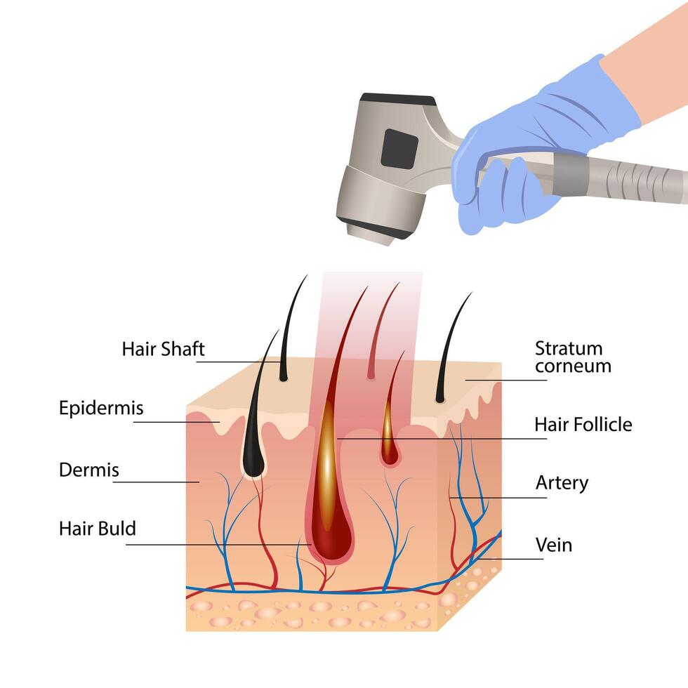 Infographics Of Hair Follicle Influence. Laser Hair Removal Procedure After Exposure To Laser Light vector
