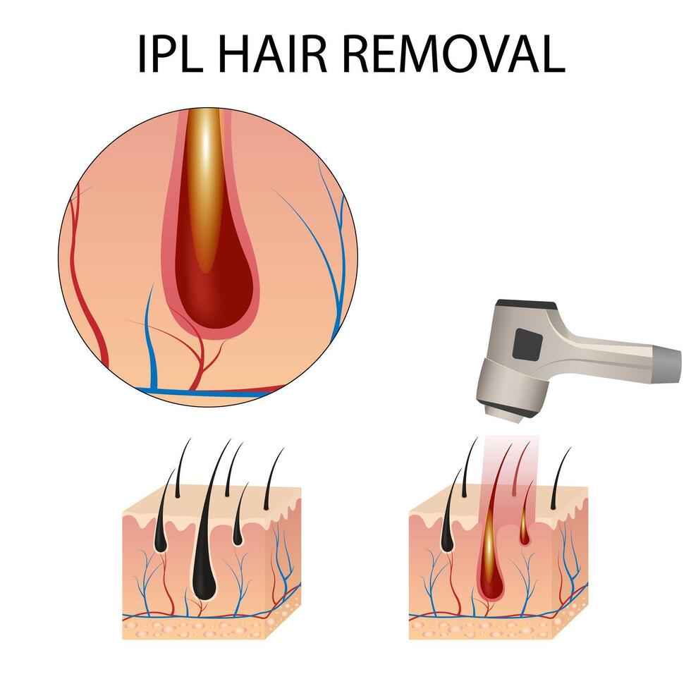 Laser hair removes the skin layer and follicles for beauty and smoothness of the body. Hair removal procedure vector