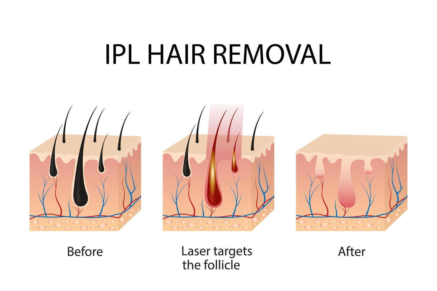 Hair follicle laser examination. Laser hair removal procedure. Step-by-step hair removal method vector
