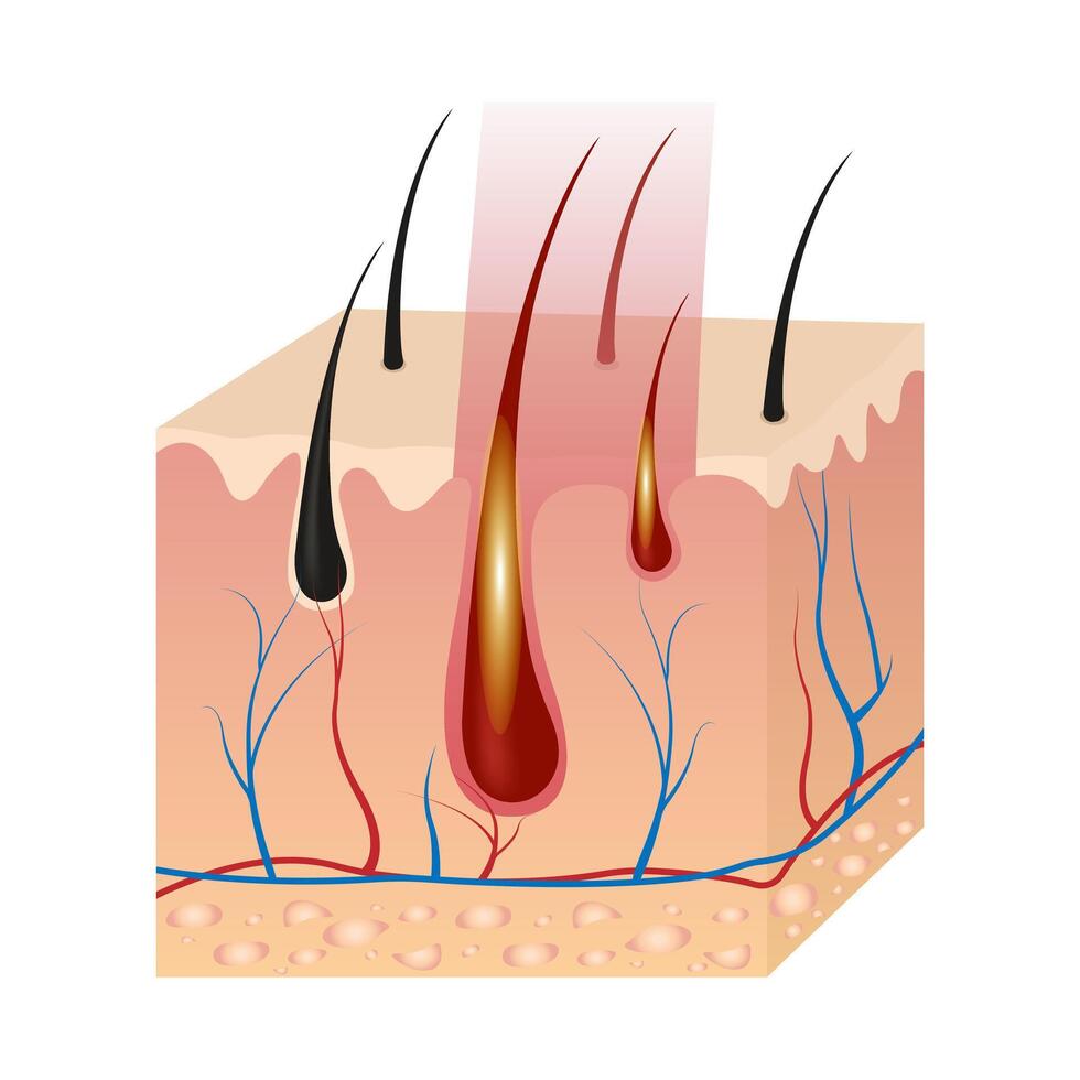 Laser Hair Removal Procedure After Exposure To Laser Light. Infographics Of Hair Follicle Influence vector