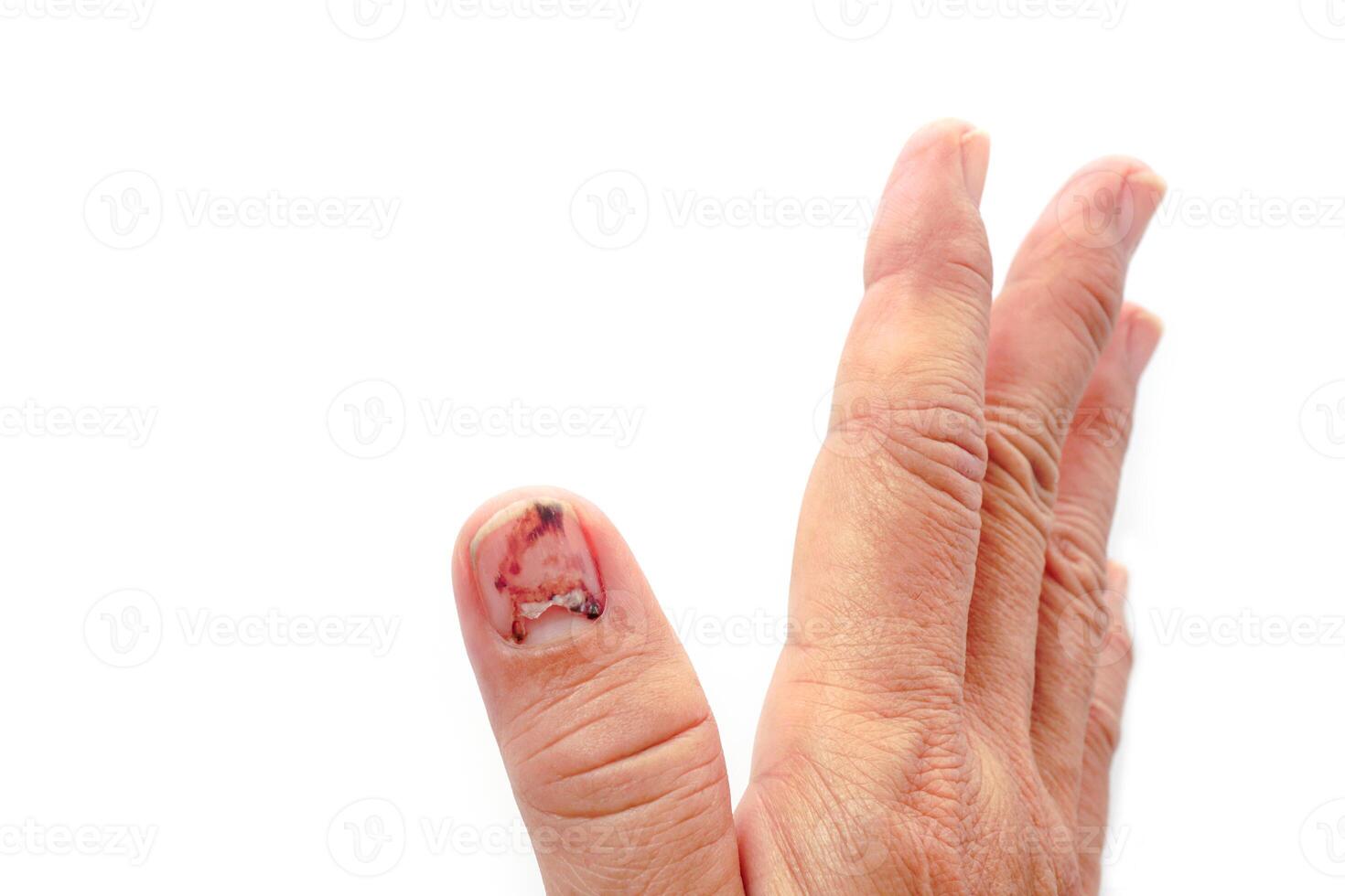 Thumb Finger with Bruised Nail, Subungual Hematoma, on White Background. Painful bruises, accident, injured fingers and medical concept. photo